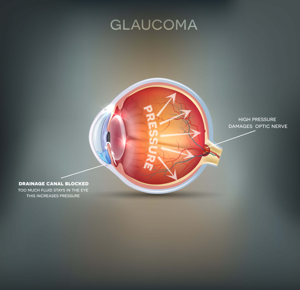Glaucoma, Blurry Vision