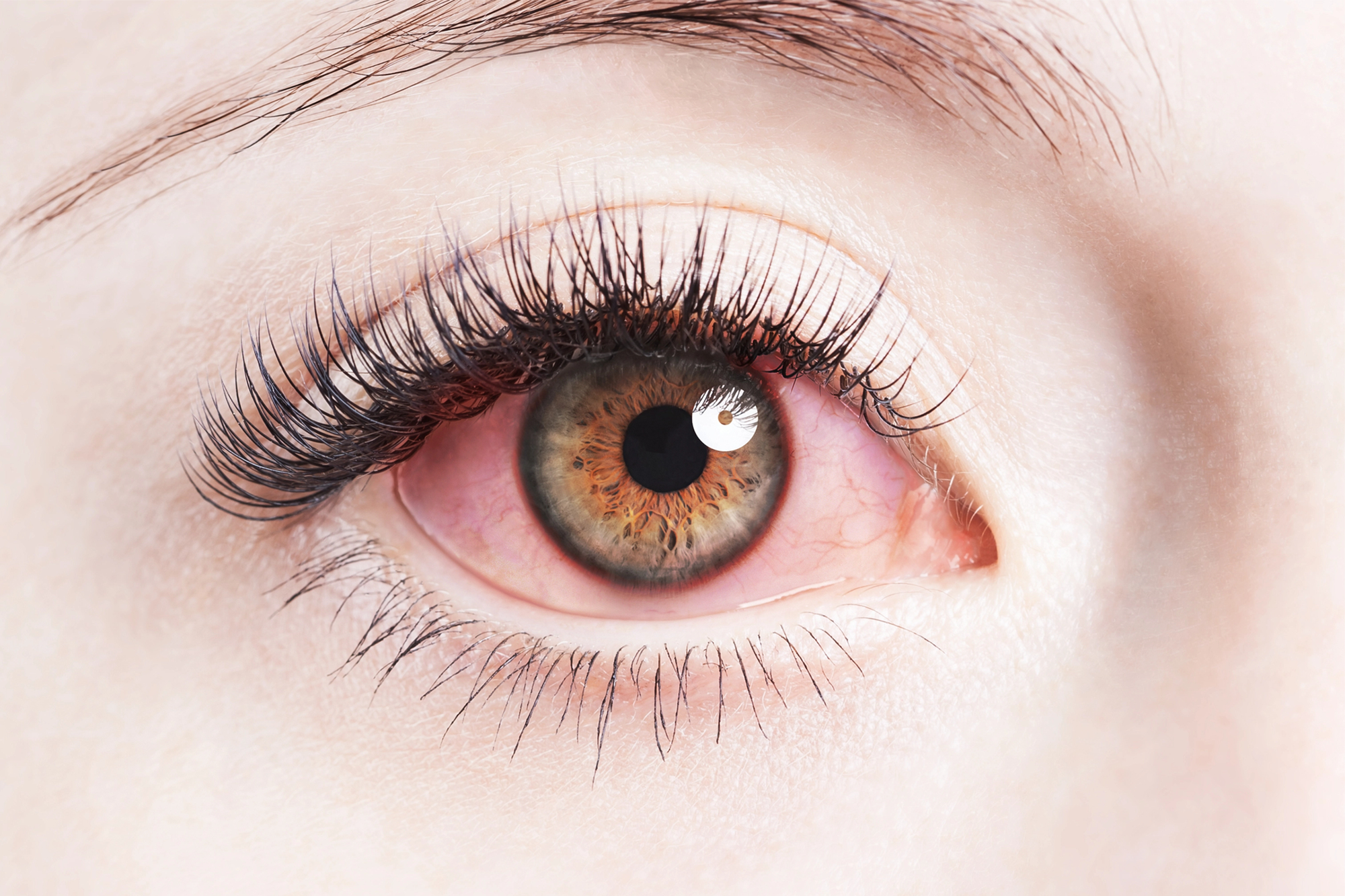 Bloodshot Eyes -
